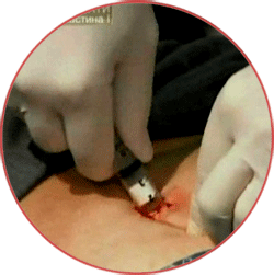 Направление на имплантацию (вшивание)